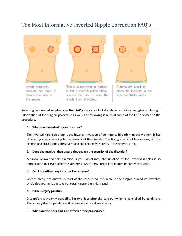 The Most Informative Inverted Nipple Correction FAQ's The Most Informative Inverted Nipple Correction FAQ's