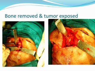 Bone removed & tumor exposed
 