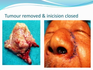 Tumour removed & inicision closed
 