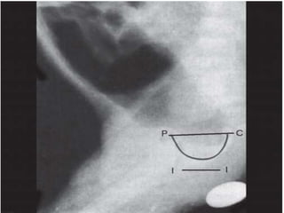 Invertogram ANORECTAL MALFORMATION ( ARM ) PRANAYA | PPTX