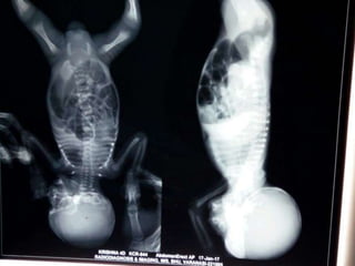 Invertogram ANORECTAL MALFORMATION ( ARM ) PRANAYA | PPTX