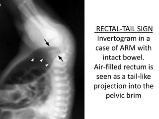Invertogram ANORECTAL MALFORMATION ( ARM ) PRANAYA | PPTX