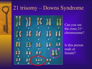 21 trisomy – Downs Syndrome Can you see the extra 21 st  chromosome? Is this person male or female? 