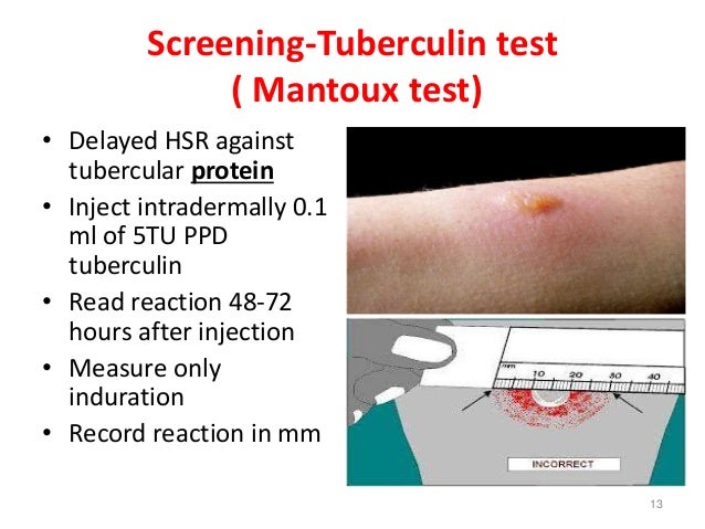 Test Di Mantoux Dopo 12 Ore Arrossato