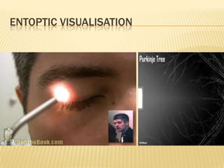 Voluntary Entoptic Visualization Investigation and management of senile cataract | PPTX