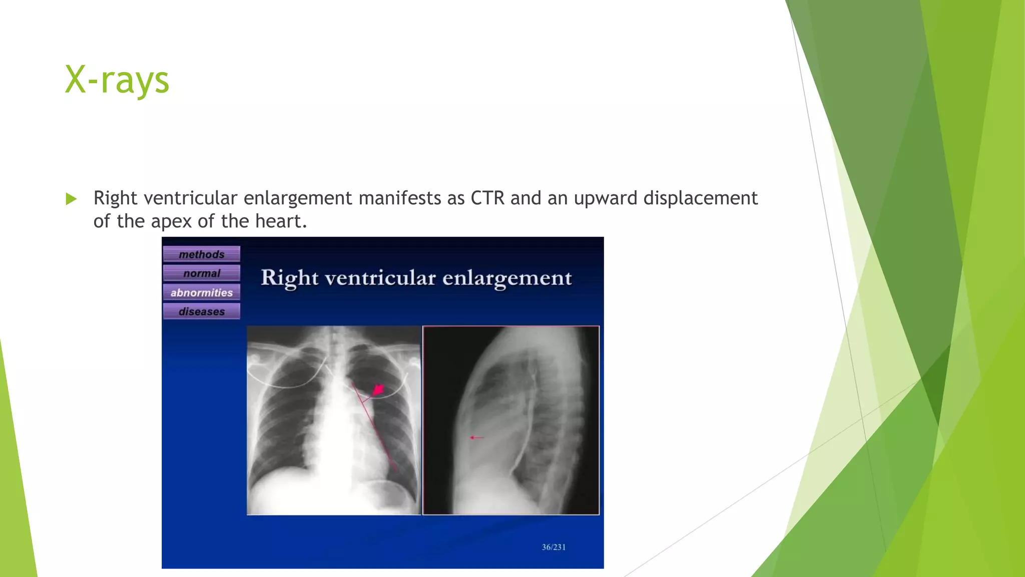 X-rays
 Right ventricular enlargement manifests as CTR and an upward displacement
of the apex of the heart.
 