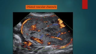 Dilated vascular channels