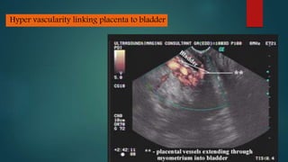 Hyper vascularity linking placenta to bladder