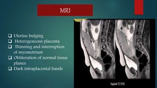 MRI
Uterine bulging
Heterogeneous placenta
Thinning and interruption
of myometrium
Obliteration of normal tissue
planes
Dark intraplacental bands