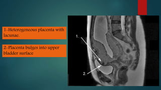 1-Heterogeneous placenta with
lacunae.
2-Placenta bulges into upper
bladder surface