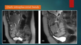 Dark intraplacental bands