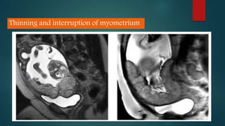 Thinning and interruption of myometrium