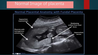 Normal Image of placenta