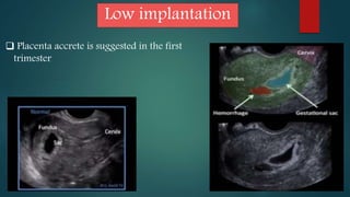 Low implantation
Placenta accrete is suggested in the first
trimester