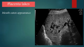 Placenta lakes
Mouth eaten appearance