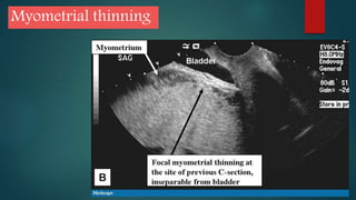 Myometrial thinning