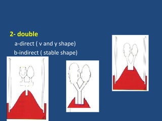 2- double
a-direct ( v and y shape)
b-indirect ( stable shape)
 