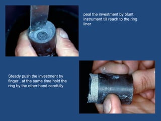 peal the investment by blunt
instrument till reach to the ring
liner
Steady push the investment by
finger , at the same time hold the
ring by the other hand carefully
 