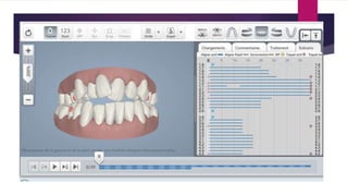 Invisalign | PPTX