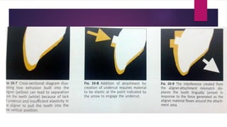 Invisalign | PPTX