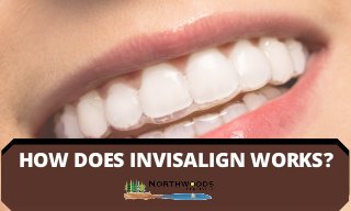 HOW DOES INVISALIGN WORKS?
 