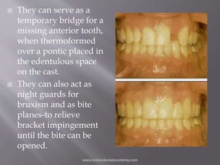  They can serve as a
temporary bridge for a
missing anterior tooth,
when thermoformed
over a pontic placed in
the edentul...