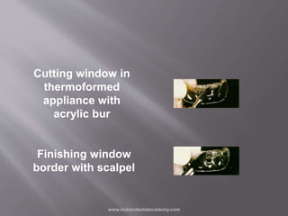 www.indiandentalacademy.com
Finishing window
border with scalpel
Cutting window in
thermoformed
appliance with
acrylic bur
 