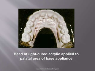Bead of light-cured acrylic applied to
palatal area of base appliance
www.indiandentalacademy.com
 