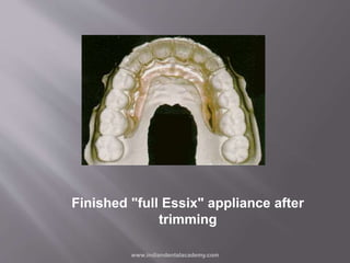 Finished "full Essix" appliance after
trimming
www.indiandentalacademy.com
 