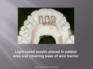 Light-cured acrylic placed in palatal
area and covering base of wire barrier
www.indiandentalacademy.com
 