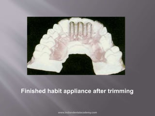 Finished habit appliance after trimming
www.indiandentalacademy.com
 