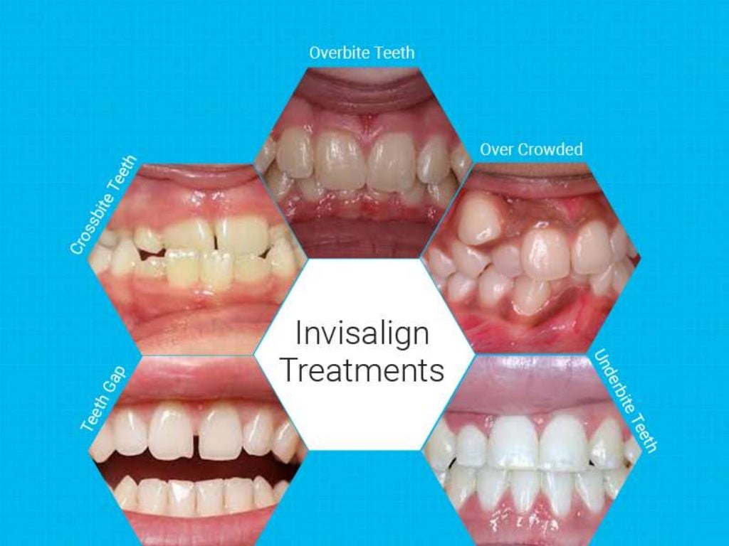 Invisalign Braces Advantages and Disadvantages
