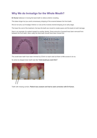 Why We do Invisalign for the Whole Mouth?
Dr Kumar believes in moving the back teeth to relieve anterior crowding.

This takes longer but you avoid unnecessary stripping of the enamel between the front teeth.

We do not carry out Invisalign Anterior or Lite as this involves enamel stripping at an early stage.

The lower the cost of the treatment, the less the teeth are moved to create space and this leads to tooth damage.

Here is an example of a patient treated by another dentist. Gross amounts of enamel have been removed from
between the front teeth, when really the back teeth should have been moved first:




The small lower teeth have been trimmed by 0.5mm on each side but there is little access to do so.

So what do stripped down teeth look like? And would you want this?




Teeth with missing corners. Patient was unaware and had to seek correction with Dr Kumar.
 