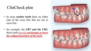 Clincheck Example Invisalign in pediatric dentistry | PPTX