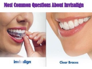 Most Common Questions About Invisalign

 