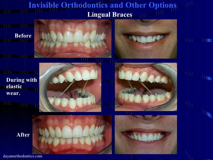 orthodontics braces
