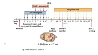 In vitro fertilization | PPTX