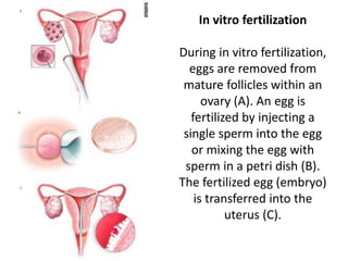 In vitro fertilization
During in vitro fertilization,
eggs are removed from
mature follicles within an
ovary (A). An egg is
fertilized by injecting a
single sperm into the egg
or mixing the egg with
sperm in a petri dish (B).
The fertilized egg (embryo)
is transferred into the
uterus (C).
 
