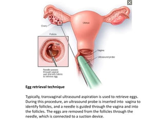 Egg retrieval technique
Typically, transvaginal ultrasound aspiration is used to retrieve eggs.
During this procedure, an ultrasound probe is inserted into vagina to
identify follicles, and a needle is guided through the vagina and into
the follicles. The eggs are removed from the follicles through the
needle, which is connected to a suction device.
 