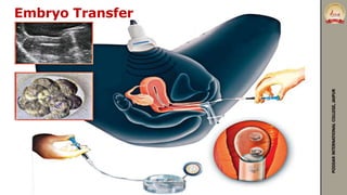 Embryo Transfer
PODDARINTERNATIONALCOLLEGE,JAIPUR
 