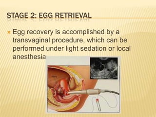 STAGE 2: EGG RETRIEVAL

   Egg recovery is accomplished by a
    transvaginal procedure, which can be
    performed under light sedation or local
    anesthesia.
 