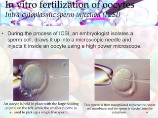 In vitro fertilization methods | PPTX