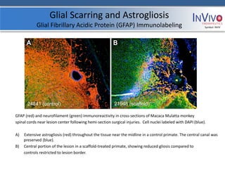 Glial Scarring and Astrogliosis
            Glial Fibrillary Acidic Protein (GFAP) Immunolabeling                                             Symbol: NVIV




GFAP (red) and neurofilament (green) immunoreactivity in cross-sections of Macaca Mulatta monkey
spinal cords near lesion center following hemi-section surgical injuries. Cell nuclei labeled with DAPI (blue).

A)   Extensive astrogliosis (red) throughout the tissue near the midline in a control primate. The central canal was
     preserved (blue).
B)   Central portion of the lesion in a scaffold-treated primate, showing reduced gliosis compared to
     controls restricted to lesion border.
 
