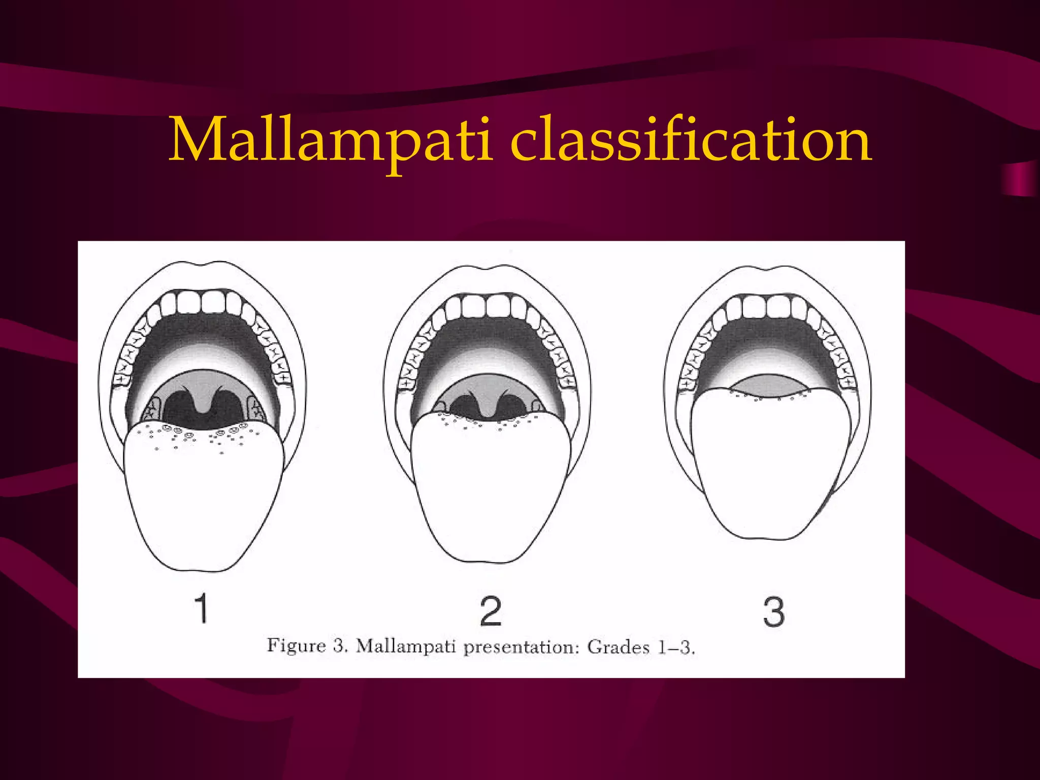 Mallampati classification
 
