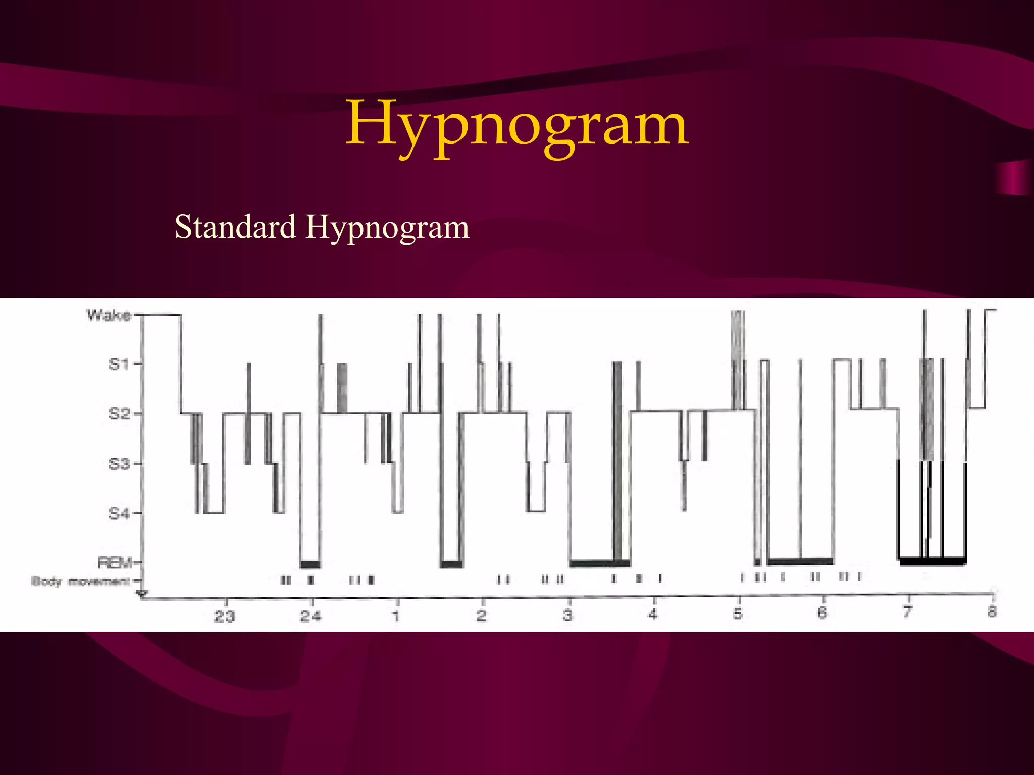 Hypnogram
Standard Hypnogram
 