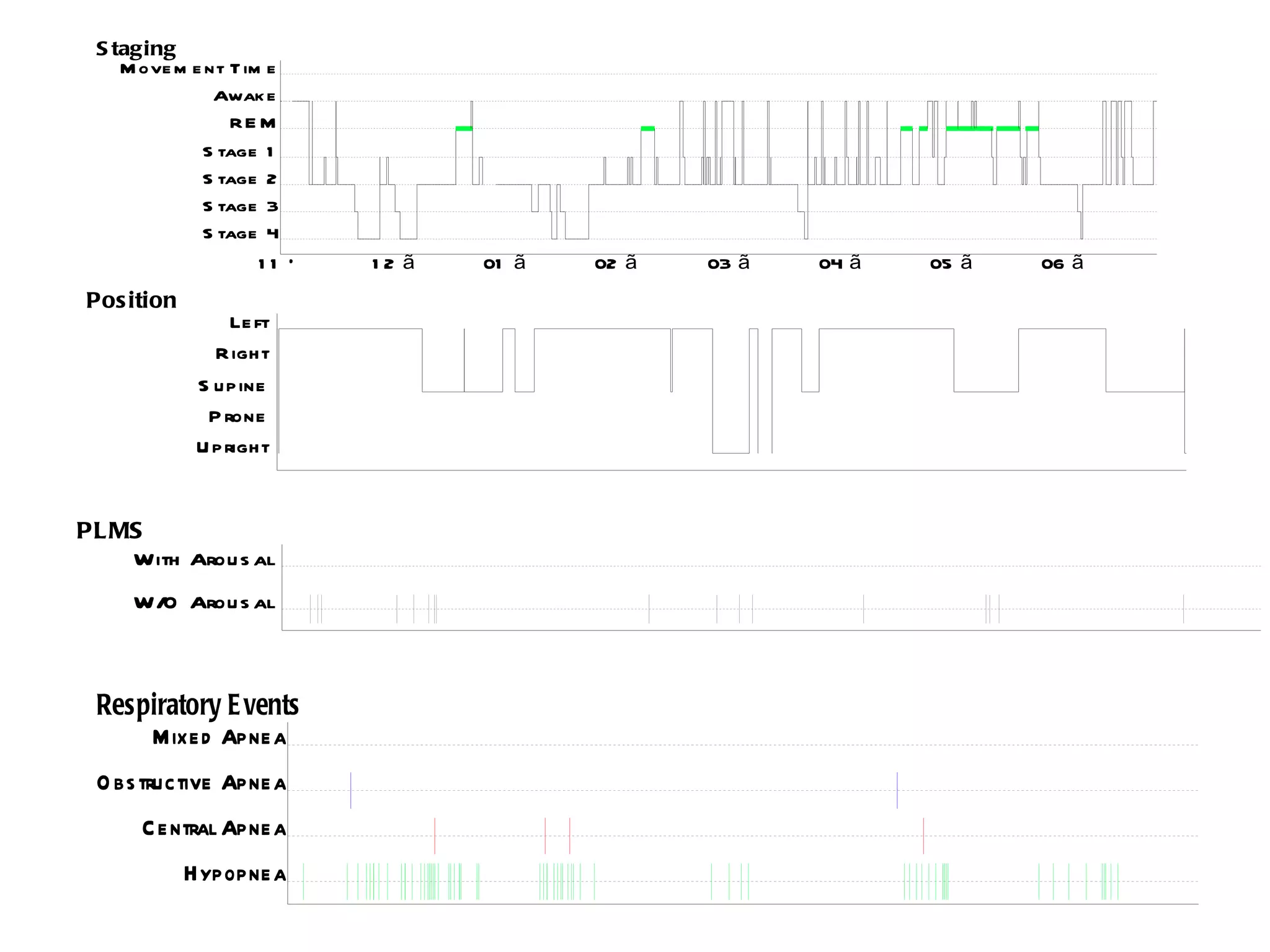 S taging
    M ove m e nt T im e
               Awak e
                 RE M
             S tage 1
             S tage 2
             S tage 3
             S tage 4
                    11 Õ   12 ã   01 ã   02 ã   03 ã   04 ã   05 ã   06 ã
Pos ition
                 Le ft
               R ight
             S upine
              P rone
             U pright


PL MS
    With Arou s al
     W/O Arou s al



 Respiratory E vents
     Mixe d Apne a
 O bs tructive Apne a
      C e ntral Apne a
            Hypopne a
 