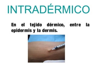 INTRADÉRMICO
En el tejido dérmico, entre la
epidermis y la dermis.
 