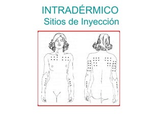 INTRADÉRMICO
Sitios de Inyección
 