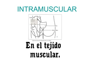 INTRAMUSCULAR
En el tejido
muscular.
 