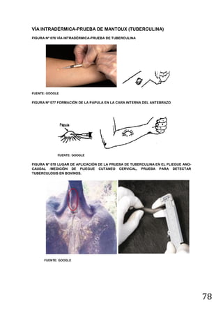 VÍA INTRADÉRMICA-PRUEBA DE MANTOUX (TUBERCULINA)
Vía Intradérmica
FIGURA Nº 076 VÍA INTRADÉRMICA-PRUEBA DE TUBERCULINA

FUENTE: GOOGLE

Prueba de Mantoux (Tuberculina).

FIGURA Nº 077 FORMACIÓN DE LA PÁPULA EN LA CARA INTERNA DEL ANTEBRAZO

FUENTE: GOOGLE

FIGURA Nº 078 LUGAR DE APLICACIÓN DE LA PRUEBA DE TUBERCULINA EN EL PLIEGUE ANOCAUDAL /MEDICIÓN DE PLIEGUE CUTÁNEO CERVICAL, PRUEBA PARA DETECTAR
TUBERCULOSIS EN BOVINOS.

FUENTE: GOOGLE

78

 